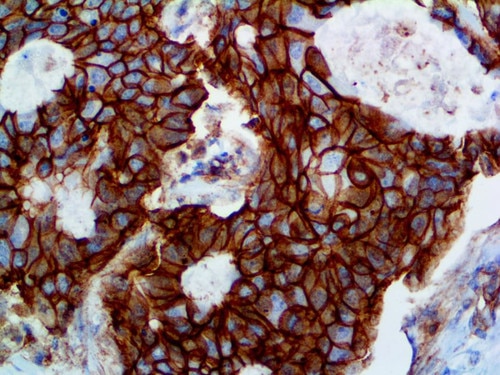 IHC of p120 Catenin on an FFPE Breast Carcinoma Tissue